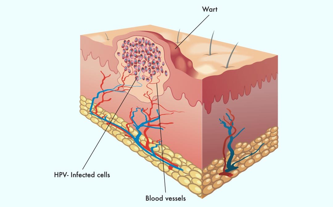 Skin Care University: Warts 101 | Summit Plastic Surgery & Dermatology